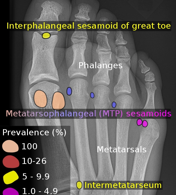 Sesamoiditis