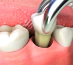Bolest dásně po vytržení zubu